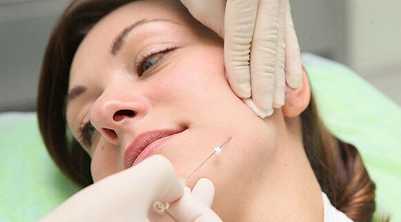Лифтинг на нишки - метод за козметично подмладяване на лицето след 45 години