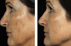 Преди и след фракционно подмладяване на лицето