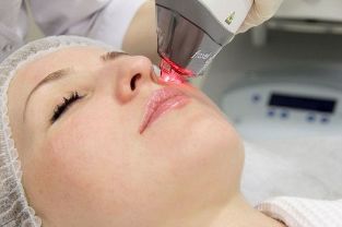 Процес на подмладяване на кожата на лицето с фракционен лазер