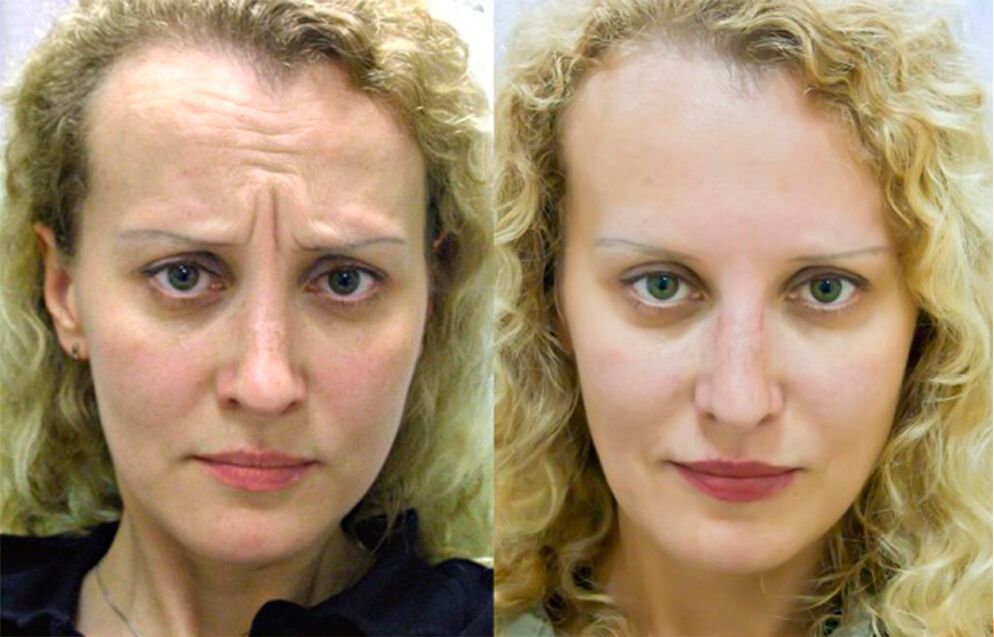 преди и след използване на масажора за подмладяване ltza снимка 1