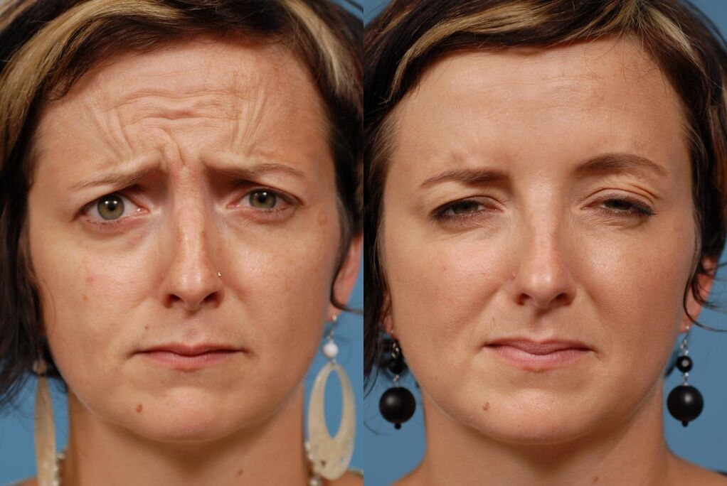 преди и след използване на масажора за подмладяване ltza снимка 2