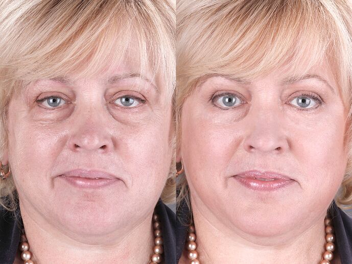 преди и след използване на масажора за подмладяване ltza снимка 3