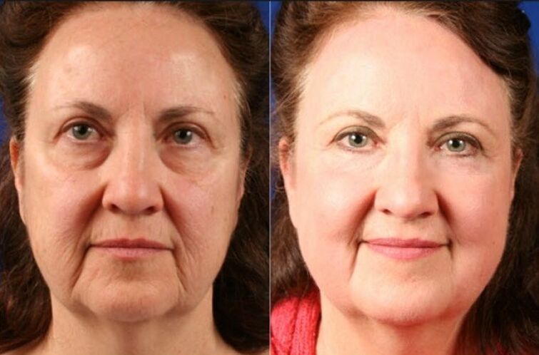 преди и след използване на масажора за подмладяване ltza снимка 6