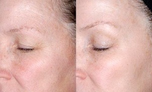 подмладяване на кожата около очите преди и след снимки