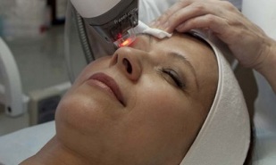 блефаропластика за подмладяване на кожата около очите