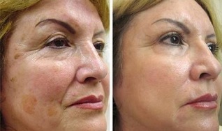 частично подмладяване на кожата преди и след снимки
