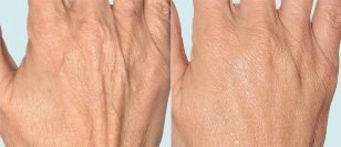 Кожа на ръцете преди и след фракционна терапия
