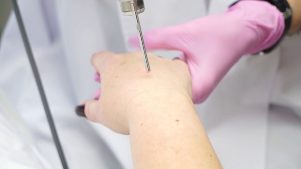 Лазерно подмладяване на кожата на ръцете