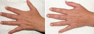 Резултатът от премахването на старчески петна по ръцете