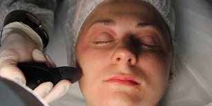 как да се подготвим за плазмената процедура за подмладяване на кожата