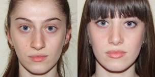 преди и след подмладяване на кожата в плазмата