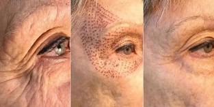 снимки преди и след плазмено подмладяване на кожата